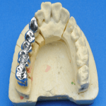 dental cobalt chrome alloy application