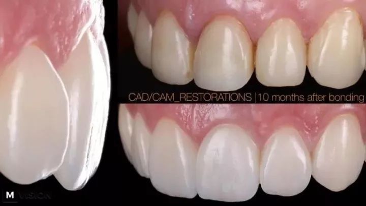 cad cam bonding of venner zirconia