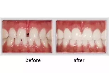 veneer teeth beauty performance