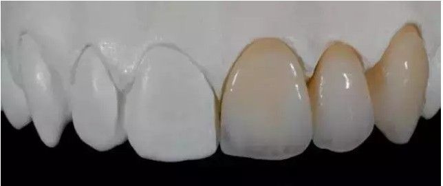 anterior veneer zirconia teeth