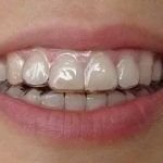Invisible-orthodontic-without-brace-on-teeth