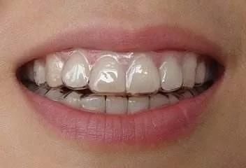 Invisible orthodontic without brace on teeth