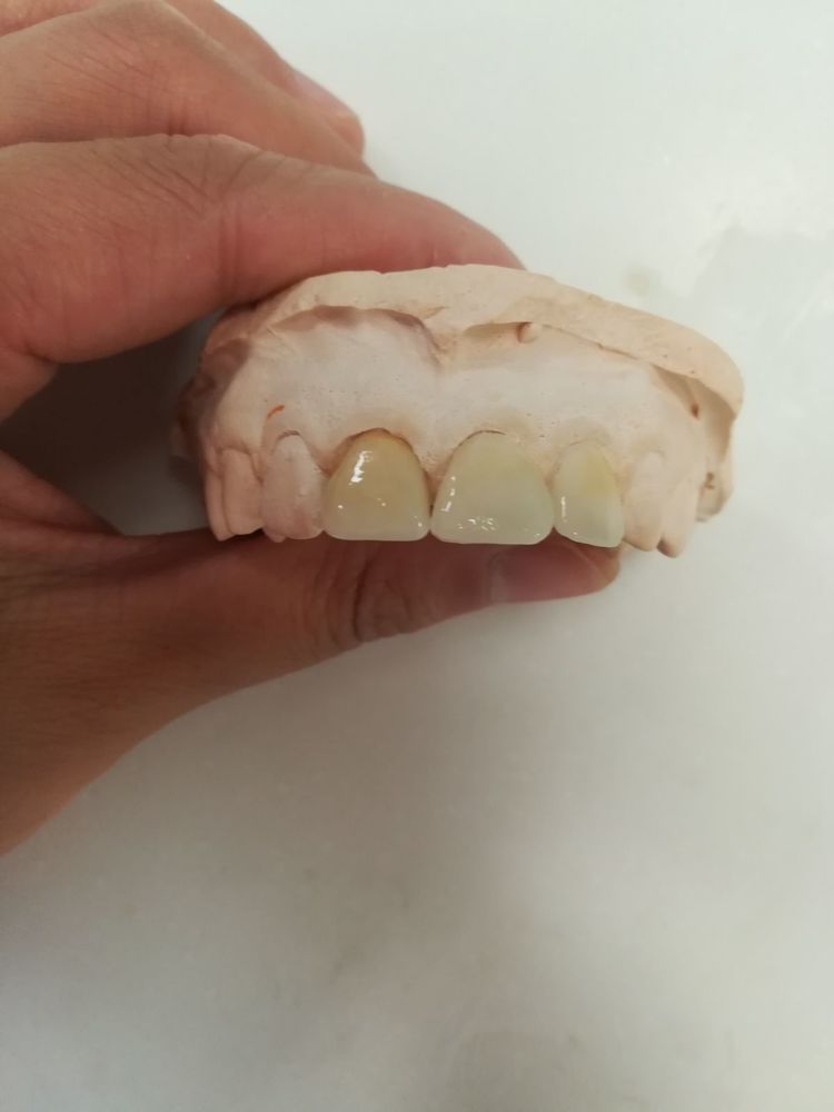 final cad cam dental restoration
