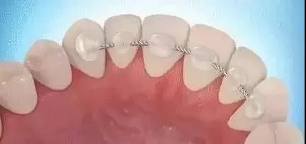 fixed retainer