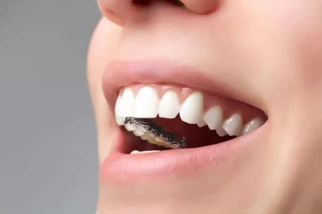 invisable orthodontics devices on teeth