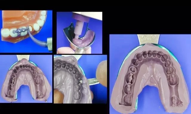 one step of the procedure of taking impression in dentist clinic