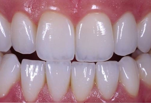 cad cam dental zirconia veneer cosmetic