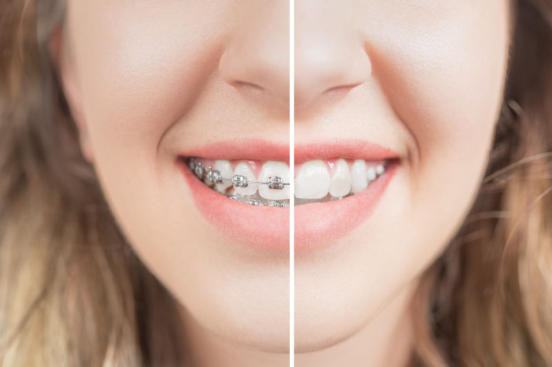 Good aesthetic self-ligating braces before and after