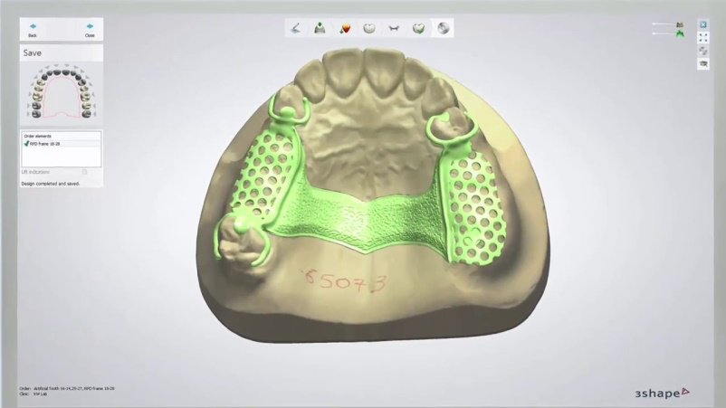 cad cam dental peek in prosthodontics design