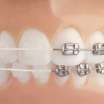 ceramic braces or metal braces choice
