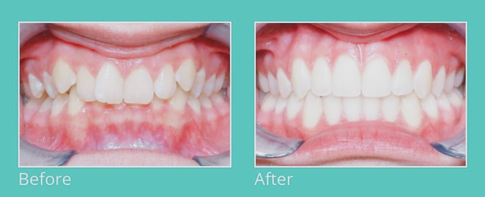 dental aligners orthodontic treatment
