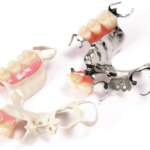 peek material in prosthodontics