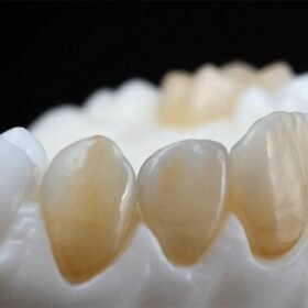 ZIRCONIA CROWNS GOOD FOR FRONT TEETH