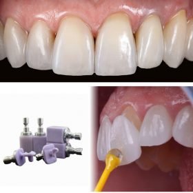 CAD CAM LITHIUM DISILICATE VENEER DENTAL RESTORATION
