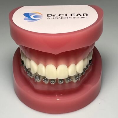 Clear aligners versus traditional metal braces for teen orthodontic treatment