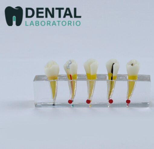 Endodontic Treatment Model with 5 stages