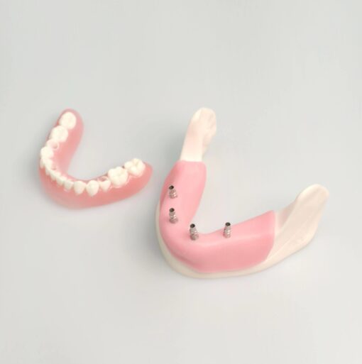all on 4 implant surgery model