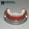 overdenture implant model