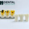 tooth caries pathology model