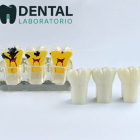 tooth caries pathology model