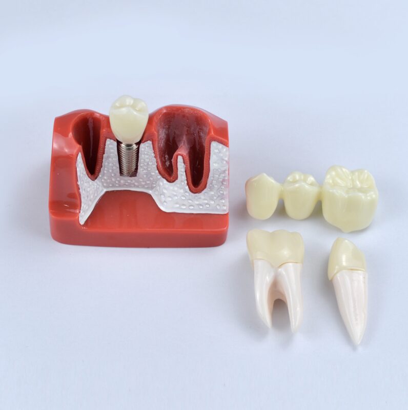 tooth implant model for patient communication and education