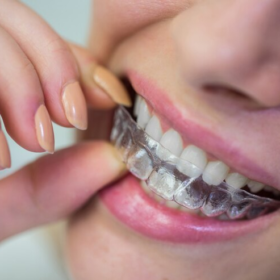 aligner treatment in orthodontics